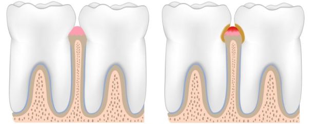 Enzündung des Zahnfleischs