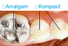 Amalgam und Komposit